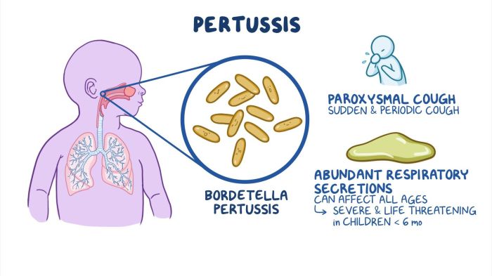 A paroxysmal cough is associated with legionnaires disease